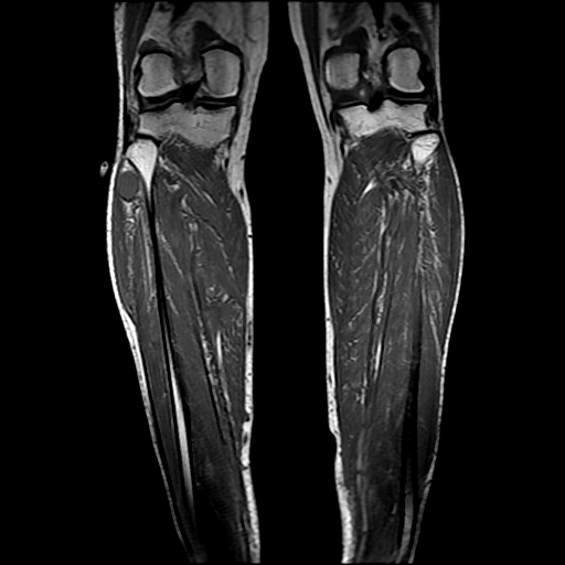 Figure 4 for case Schwannoma ( RID4473 )